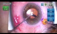 Pars-Plana-Technik für malignes Glaukom