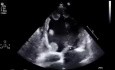 Echokardiographischer Nachweis kleiner endokardialer Thromben des linken Ventrikels bei schwerer systolischer Dysfunktion