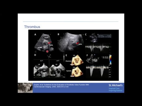 Echokardiographische Beurteilung der Funktion der Aortenklappenprothese
