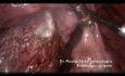 Entfernung vom Myom des Isthmus uteri und des Gebärmutterhalses