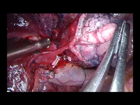 Ungeschnittene uniportale VATS – anatomische Segmentektomie des vorderen Segments (S3) rechts
