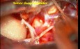 Hirntumor-Trigeminus-Schwannom – Mikrochirurgische Exzision