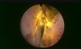GreenLEP - GreenLight- Laser-Enucleation der Prostata