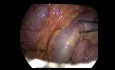 Blindschleifenresektion nach Jejunum-Jejunum-Anastomose bei einem Patienten mit Magenbypass nach der Roux-en-Y-Methode