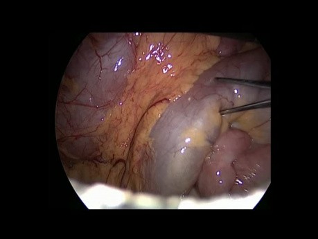 Blindschleifenresektion nach Jejunum-Jejunum-Anastomose bei einem Patienten mit Magenbypass nach der Roux-en-Y-Methode