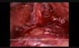Laparoskopische Cholezystektomie bei Patienten mit Gallensteinen und Leberzirrhose
