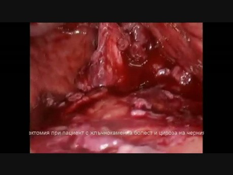 Laparoskopische Cholezystektomie bei Patienten mit Gallensteinen und Leberzirrhose
