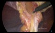 Laparoskopische Reparatur von inkarzerierten Bauchhernien