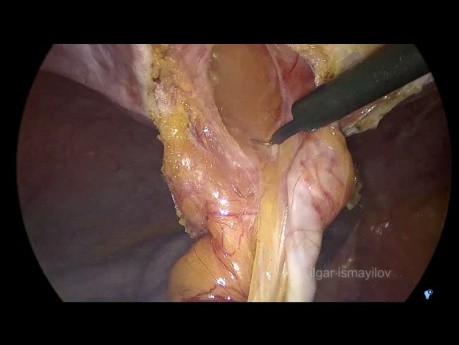 Laparoskopische Reparatur von inkarzerierten Bauchhernien