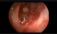 Sphenochoanaler Polyp / Oberste Nasenmuschel / Pulsation der A. carotis interna 