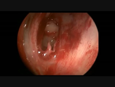 Sphenochoanaler Polyp / Oberste Nasenmuschel / Pulsation der A. carotis interna 