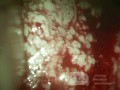 Zervikales Adenokarzinom (Carcinoma glandulare colli uteri)