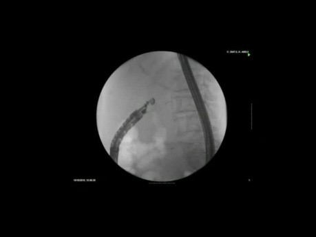 EUS-gestützte Choledochoduodenostomie