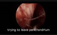 Septummukositis