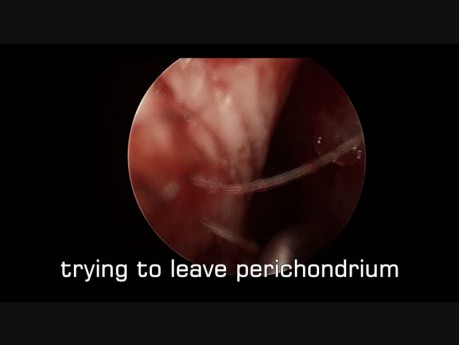 Septummukositis