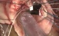 Wechsel der Aortenklappe – die chirurgische Technik.