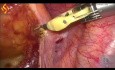 Laparoskopische anteriore Rektumresektion und Keilresektion der Leber