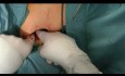 Implantation von Schmerzpumpe