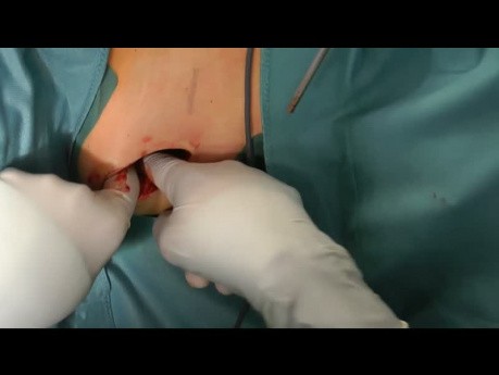 Implantation von Schmerzpumpe