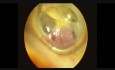 Paraganglioma tympanicum links