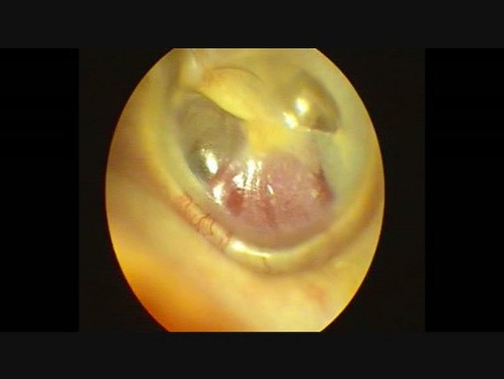 Paraganglioma tympanicum links