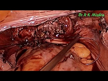 Laparoskopische Hysterektomie mit Sakrokolpopexie beim Uterusprolaps 