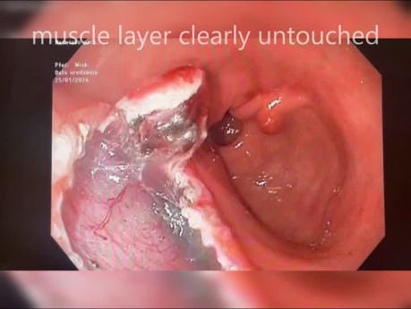 Antral ESD