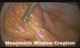 Laparoskopische Resektion der Giant Mucozele der Appendix vermiformis (Zystadenom)