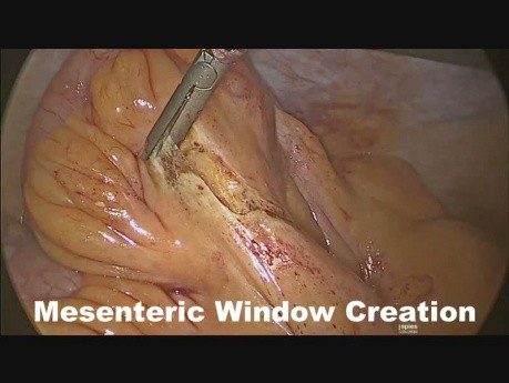 Laparoskopische Resektion der Giant Mucozele der Appendix vermiformis (Zystadenom)