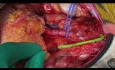End-zu-End-Anastomose A. epigastrica inferior zur unteren Polararterie
