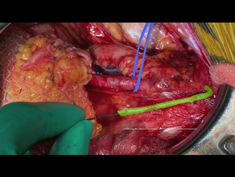 End-zu-End-Anastomose A. epigastrica inferior zur unteren Polararterie