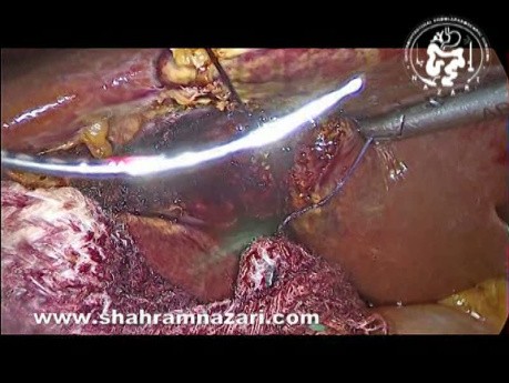 Nachlässigkeit und Schäden an den Gefäßen im Bereich der Leber und der Gallenblase