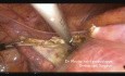 Hysterektomie bei Uterus myomatosus