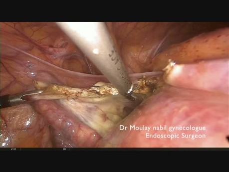 Hysterektomie bei Uterus myomatosus