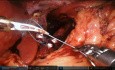 Robotische Cruroplastik (Hiatoplastik) und Nissen-Fundoplikatio bei GERD und Typ-I-Hernie des Hiatus oesophageus