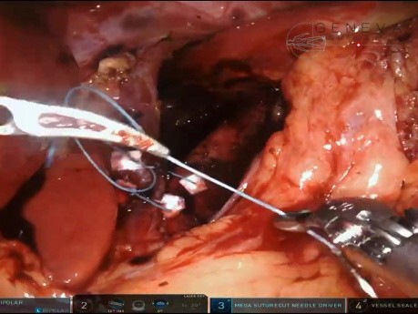 Robotische Cruroplastik (Hiatoplastik) und Nissen-Fundoplikatio bei GERD und Typ-I-Hernie des Hiatus oesophageus