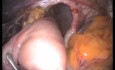 Von der konventionellen Laparoskopie zur Laparoskopische Einzelzugangchirurgie: Der Weg für gastroösophageale Refluxkrankheit