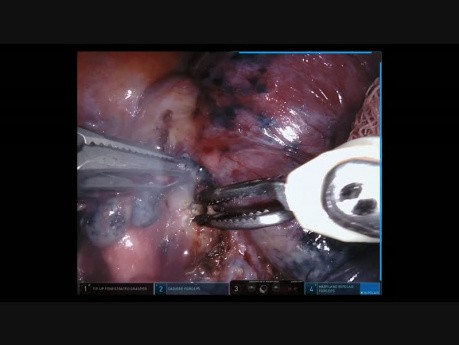 Lobektomie Unterlappen rechts - roboterassistierte Chirurgie