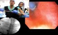 Ösophageale SEMS-Implantation – Tipps und Tricks