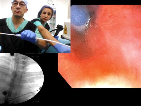 Ösophageale SEMS-Implantation – Tipps und Tricks
