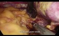 Totale laparoskopische D2-Gastrektomie