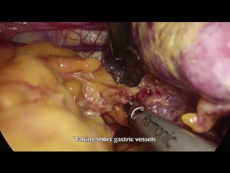 Totale laparoskopische D2-Gastrektomie