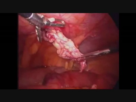 Laparoskopische Richters Hernia Reparatur