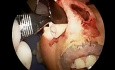 Syndrom der leeren Nase - Allotransplantatimplantation
