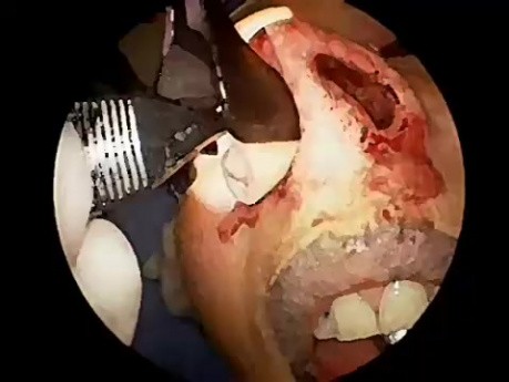 Syndrom der leeren Nase - Allotransplantatimplantation