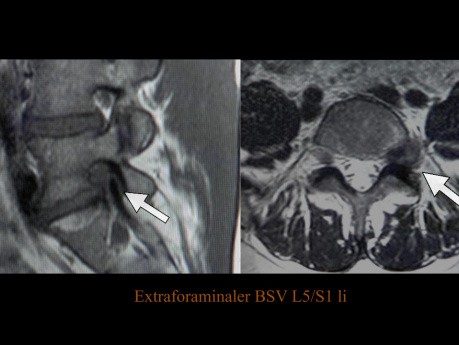 Extraforaminaler Bandscheibenvorfall