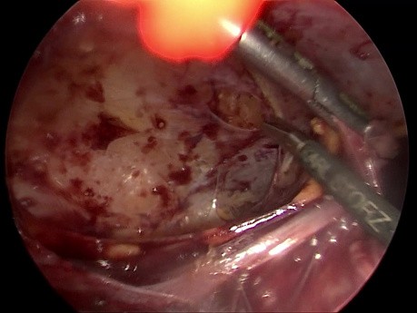 Laparoskopisches Vorgehen bei Meckel-Divertikulitis im voroperierten Abdomen