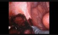  Entfernung der Endometriose mit Sigmoid Kolektomie und intrakorporaler Anastomosierung