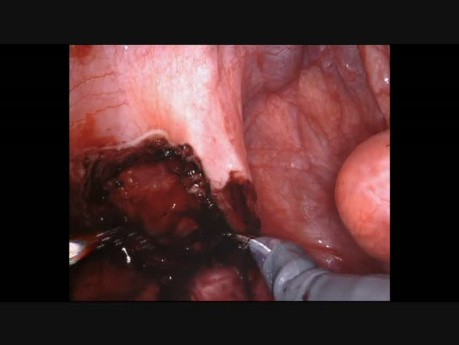  Entfernung der Endometriose mit Sigmoid Kolektomie und intrakorporaler Anastomosierung