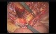 Laparoskopische TAPP-Hernienreparatur bei linker Schenkelhernie